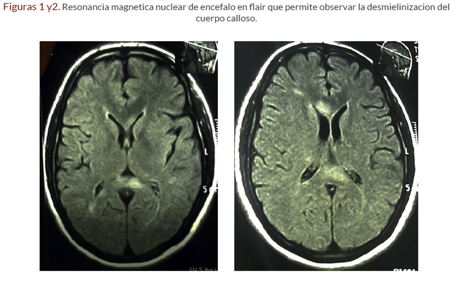 resonancia magnética nuclear